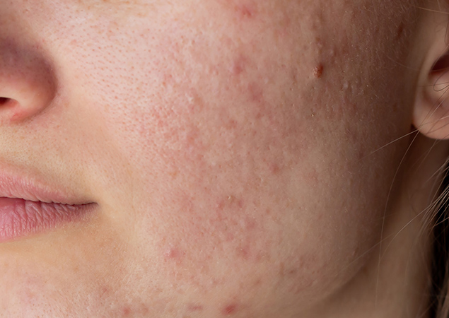 Before and After Acne Treatment