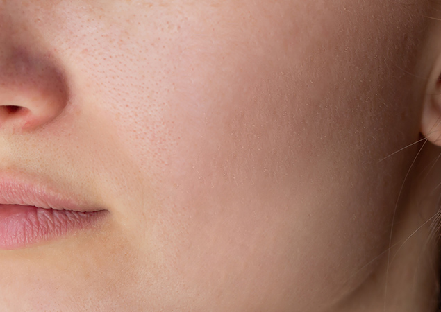 After Acne Treatment